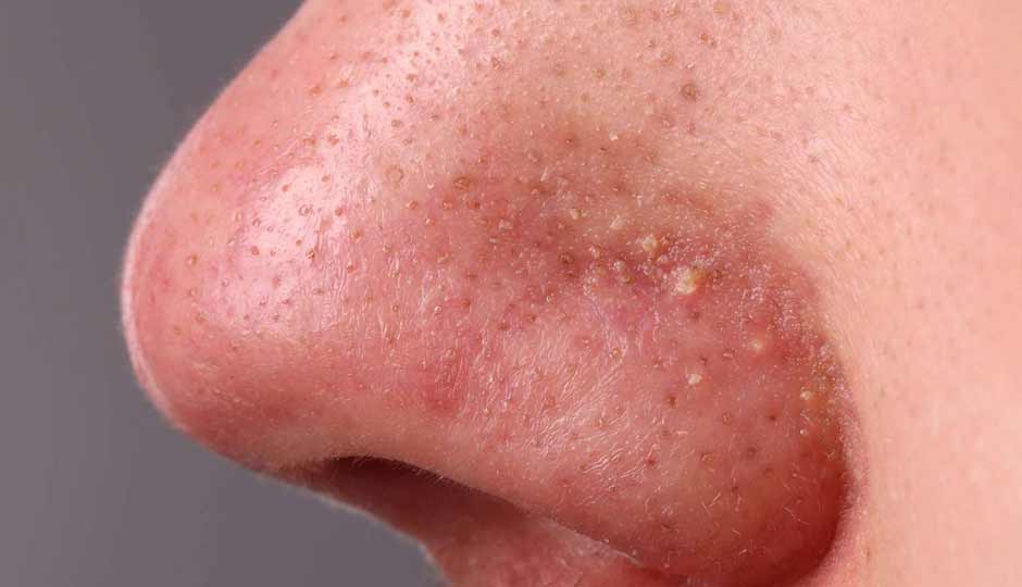 7 Home Remedies for Pimples on the Nose