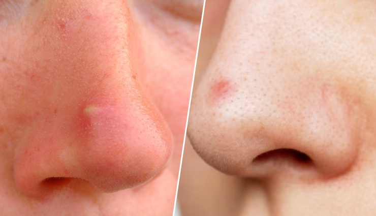 8 Effective Home Remedies To Treat Pimples on Nose