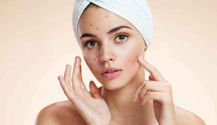 5 Remedies To Reduce Pimple Redness