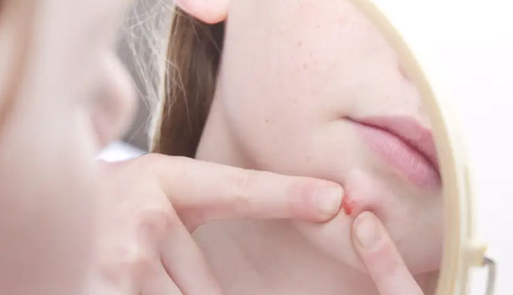 get rid of pimples in 1 day,home remedies,home remedy for pimples,skin care tips,beauty tips