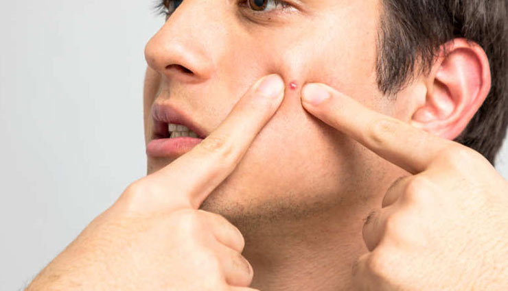 Want To Get Rid of Pimples in 1 Day? Try These Quick Remedies