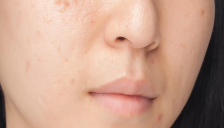 मुंहासों के निशान बन रहे चहरे की परेशानी, इन नुस्खों की मदद से पाए निखार
