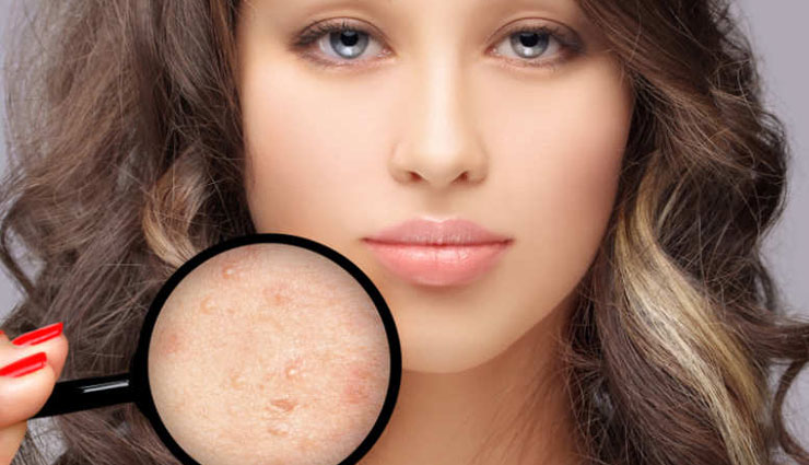 5 Tips To Get Rid of Pimples Quickly