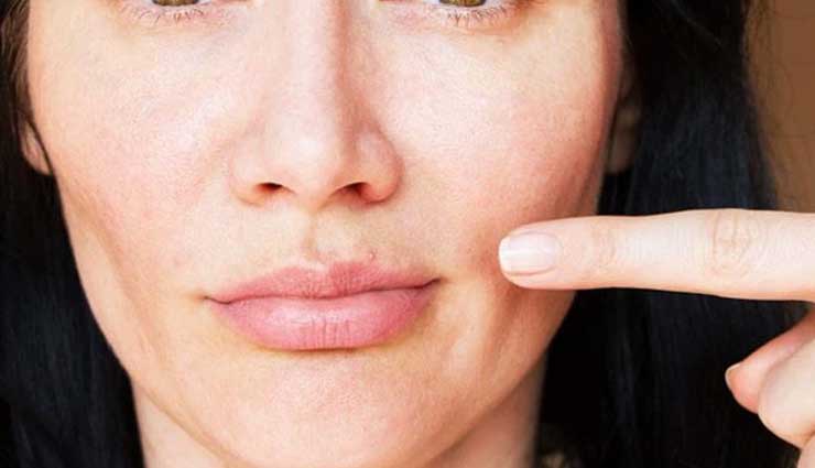 5 Ways To Treat Pimples Naturally 