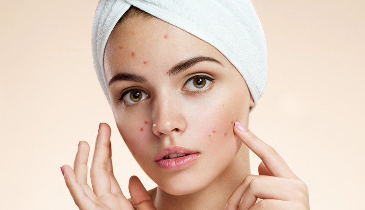 8 Ayurvedic Ways To Get Rid of Pimples