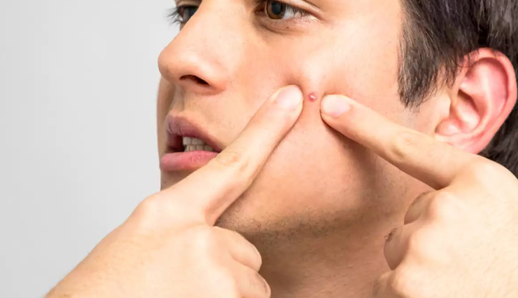 क्या पिम्पल्स खराब कर रहे आपके चहरे का लुक, इन 10 तरीकों से करें इन्हें त्वचा से दूर 
