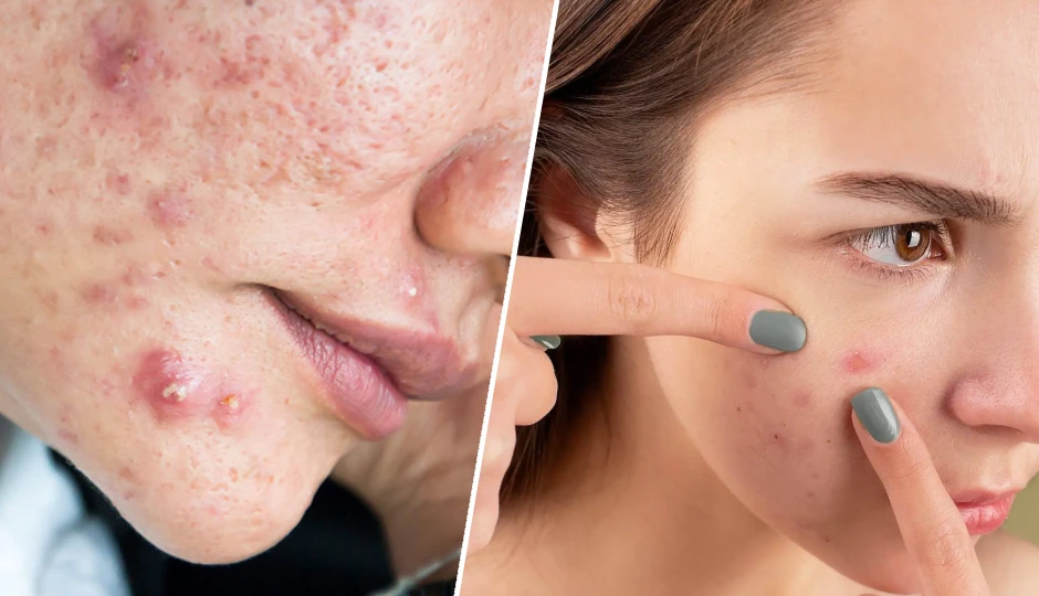 पिंपल्स और ऑयली स्किन से छुटकारा पाने के आसान और असरदार तरीके