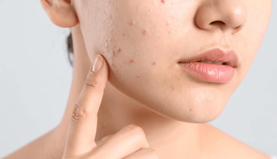 7 Home Remedies To Treat Pimples in Summer
