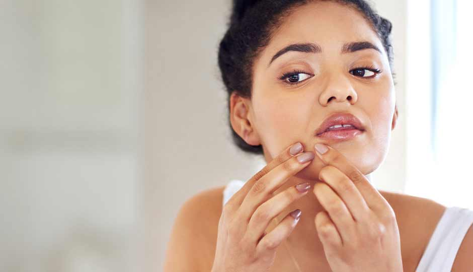10 Effective Home Remedies to Treat Pimples During Monsoon