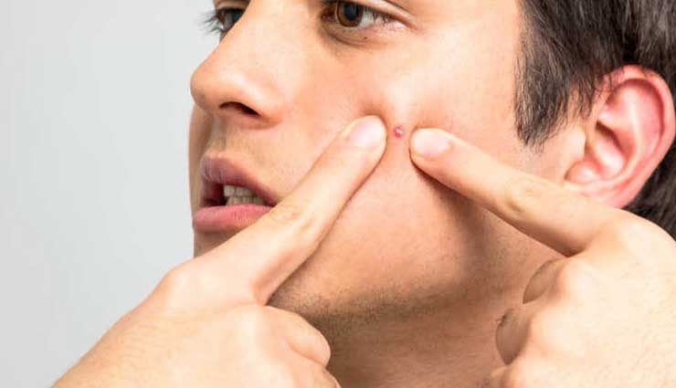 ways to treat pimples,natural tips to treat pimples,pimple care tips,skin care tips,beauty tips