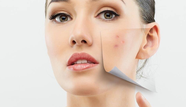 effective home remedies to treat pimples,ways to treat pimples,skin care tips,beauty tips,home remedies