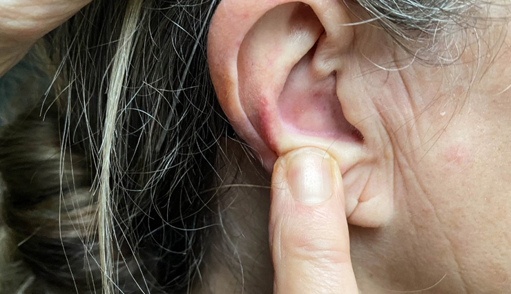 7 Natural Remedies To Treat Pimple In Ear