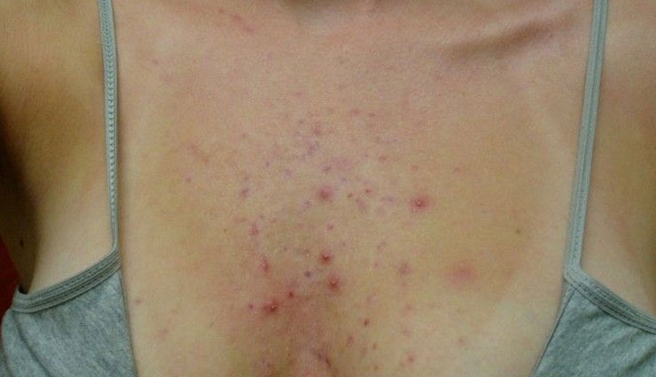 pimples on chest,home remedies,remedies to treat pimples on chest,skin care tips,beauty tips