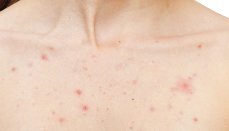 5 Home Remedies To Treat Pimples on Chest