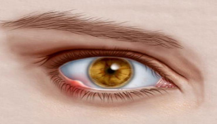 आँख की गुहेरी को दूर करने के उपचार