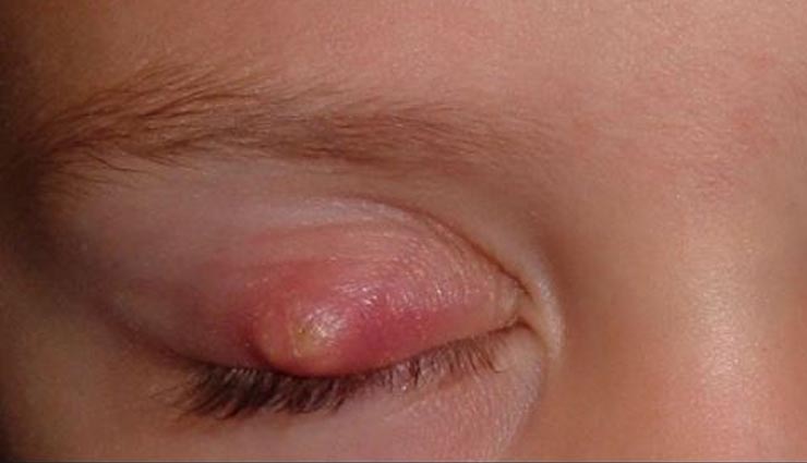 home remedies for pimples on eyes. health benefits in hindi,eyes pimples
