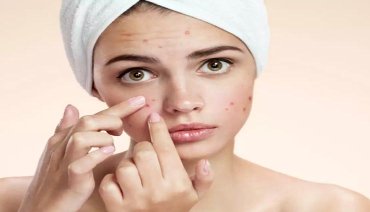क्या आप भी हैं पिंपल्स की समस्या से परेशान, जरूर आजमाए ये घरेलू नुस्खें