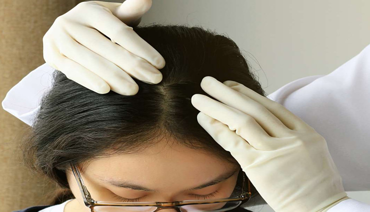 मॉनसून में आती हैं स्कैल्प पर पिंपल्स की समस्या, करें ये उपाय