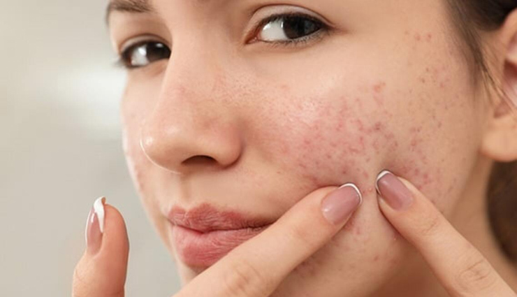 pimples,causes of pimples in hindi,pimples news in hindi,skin care tips in hindi,pimples in hindi