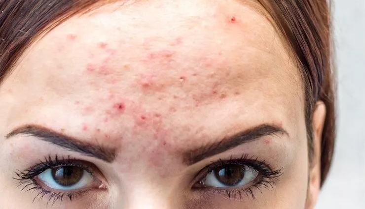 blind pimple under the skin remedies,how to treat a concealed pimple,getting rid of under-the-skin pimples,skin blemish prevention tips,home remedies for blind pimples,concealed pimple treatment,preventing hidden skin pimples,skin care for subcutaneous pimples,natural remedies for under-the-skin acne,pimple prevention and remedies