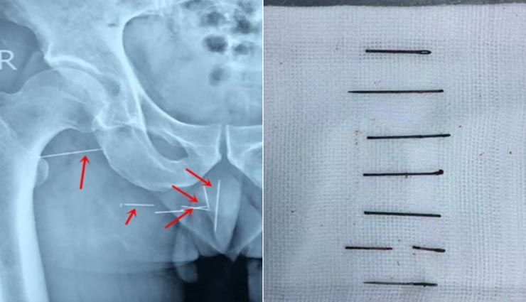 weird news,weird issue,chins,chen,8 metal needles stuck in butt
