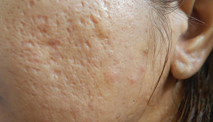 7 Must Try Remedies To Get Rid of Pitted Acne Scars