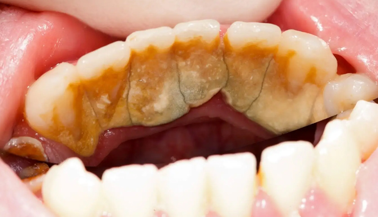 9 Home Remedies for Plaque and Tartar