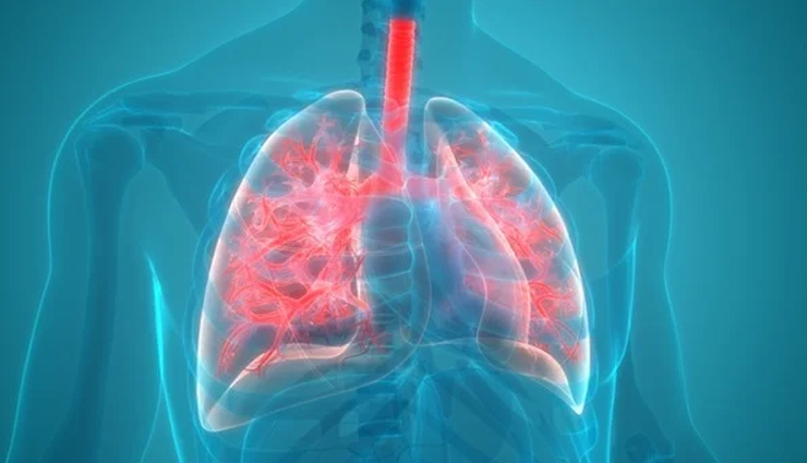 10 Natural Remedies To Treat Pneumonia at Home