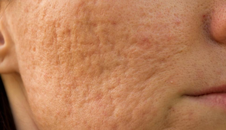 8 Natural Ways To Get Rid Of Pockmarks + Causes