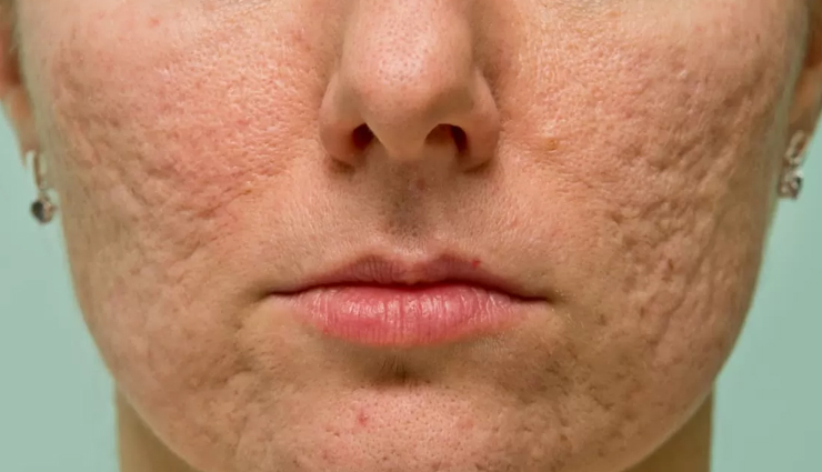 natural ways to get rid of pockmarks,pockmark removal methods,treating pockmarks naturally,causes of pockmarks,pockmark scars remedies,home remedies for pockmark removal,get rid of pockmarks naturally,pockmark treatment options,reduce pockmarks naturally,causes and solutions for pockmarks,effective pockmark remedies,holistic approaches for pockmark removal