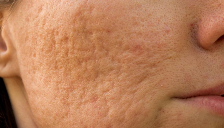 5 Simple Home Remedies To Treat Pockmarks on Skin