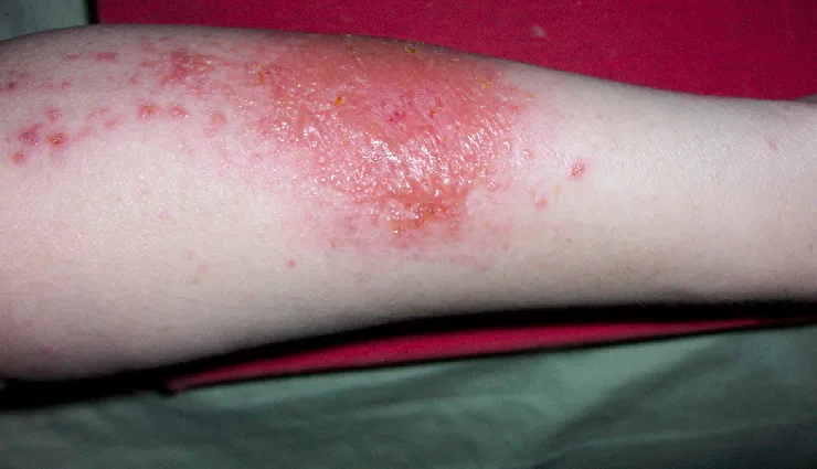 allergy symptoms,common allergies,types of allergies,food allergy,drug allergy,pollen allergy,mold allergy,seasonal allergy,latex allergy,pet allergy,allergy triggers,causes of allergy,immune system reaction,allergy management