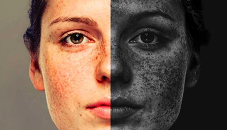 बढ़ता प्रदूषण छीन रहा त्वचा की रंगत, इन उपायों से दूर करें चहरे का कालेपन 