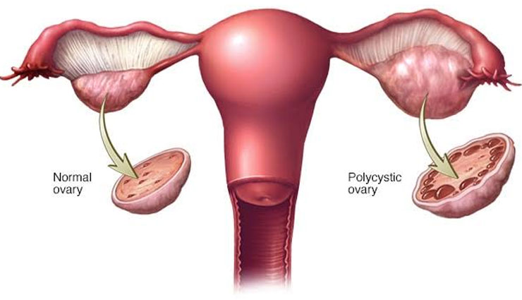 apple cider vinegar,apple cider vinegar benefits,bacteria,arthritis pain,assists weight loss,treats polycystic ovary syndrome,reduces bad cholesterol,controls blood sugar levels,Health,health benefits