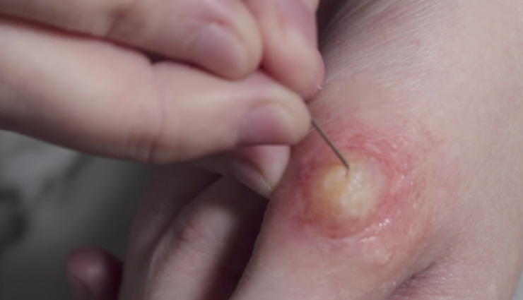 treating blisters,home remedies to treat blisters,healthy living,Health tips