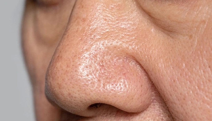 witch hazel benefits,witch hazel for skin,natural skin remedies,acne treatment with witch hazel,soothe skin irritation,astringent for oily skin,skincare routine tips,herbal skincare ingredients,clear skin remedies,witch hazel uses,glowing skin tips