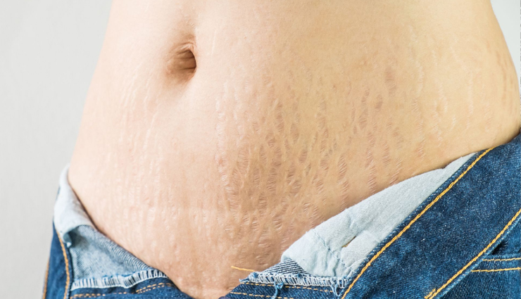 5 Remedies To Help You Get Rid of Stretch Marks Post Pregnancy