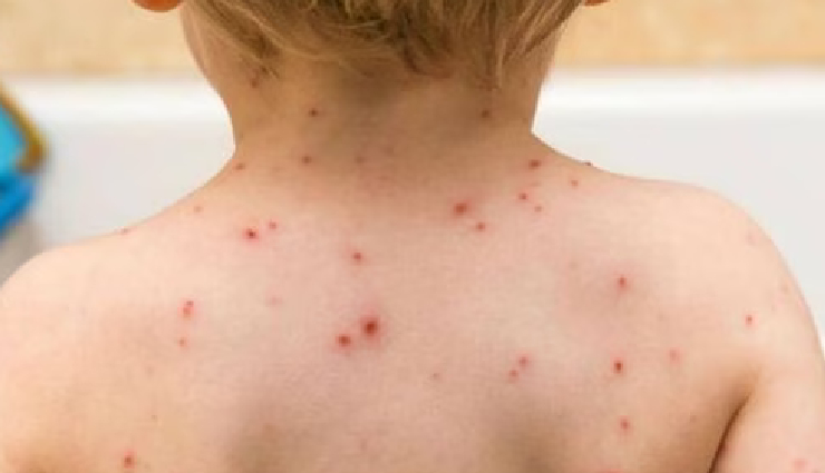 monkeypox symptoms,monkeypox rash,monkeypox fever,monkeypox headache,monkeypox muscle aches,monkeypox swollen lymph nodes,monkeypox skin lesions,monkeypox transmission,monkeypox prevention,monkeypox outbreak,monkeypox zoonotic virus,monkeypox vaccination,monkeypox public health,monkeypox infection control,monkeypox orthopoxvirus