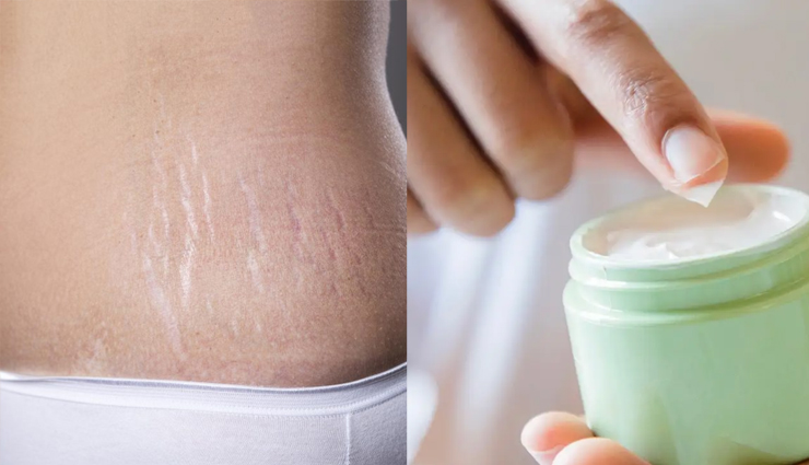 pregnancy stretch marks,homemade treatment of pregnancy stretch marks,stretch marks,beauty,beauty tips