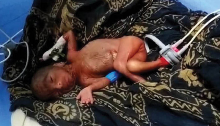 अलवर : सरकारी अस्पताल की बड़ी लापरवाही, प्री-मैच्योर बच्ची को मरा समझ सौप दिया परिजनों को; सांसें चलती देख दूसरे अस्पताल में कराया भर्ती