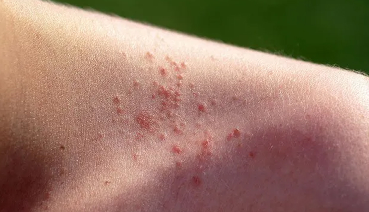 monsoon skin problems,skin issues during rainy season,common skin problems in monsoon,home remedies for monsoon skin problems,natural remedies for rainy season skin issues,getting rid of skin problems in the monsoon,monsoon skincare tips,treating skin problems during rainy season,monsoon skincare home remedies,healthy skin in the monsoon