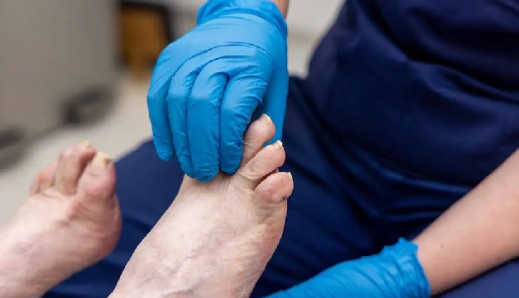 corns and calluses,corns and calluses treatment,symptoms of corns,symptoms of calluses,causes of corns,causes of calluses,how to treat corns,how to treat calluses,home remedies for corns,home remedies for calluses