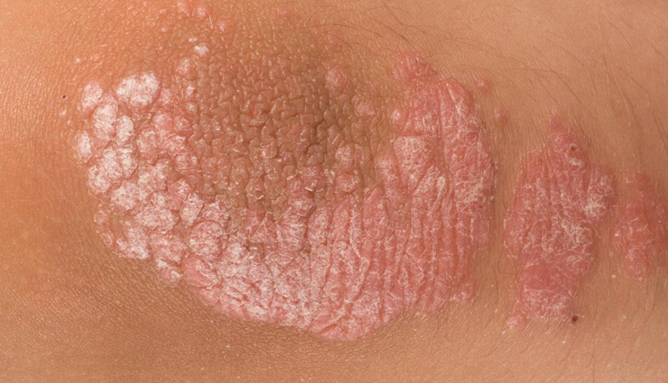 echinacea,echinacea health benefits,echinacea health tips,healthy food echinacea,echinacea good for health,echinacea healthy food,Health,Health tips