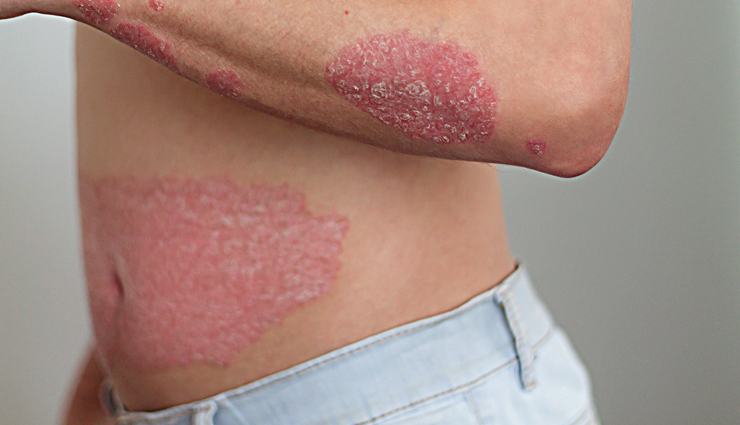 5 Things You Can Use in Place of Soap for Psoriasis