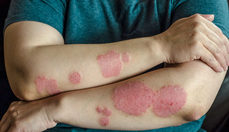 remedies to prevent eczema in winters,beauty tips,beauty hacks