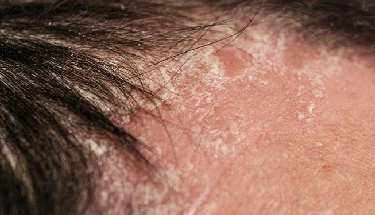 types of dandruff,dry scalp dandruff,oily scalp dandruff,fungal dandruff,psoriasis dandruff,seborrheic dermatitis,types of scalp conditions,dandruff causes,scalp health awareness,dandruff prevention tips