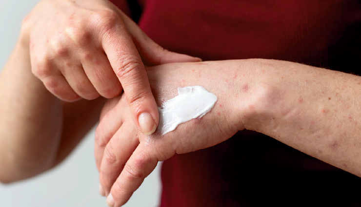 सर्दियों में क्यों बढ़ जाती है सोरायसिस की समस्या, कारण, बचाव के उपाय psoriasis in winter,psoriasis causes,psoriasis prevention tips,winter skin care for psoriasis,managing psoriasis in cold weather,causes of psoriasis flare-ups,preventive measures for psoriasis,winter skincare tips,psoriasis treatment,psoriasis triggers
