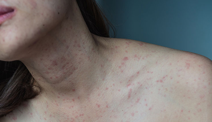 7 Home Remedies To Ease Psoriasis Symptoms