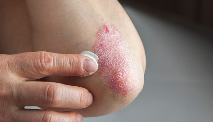 9 Ways To Get Rid of Psoriasis Symptoms Naturally