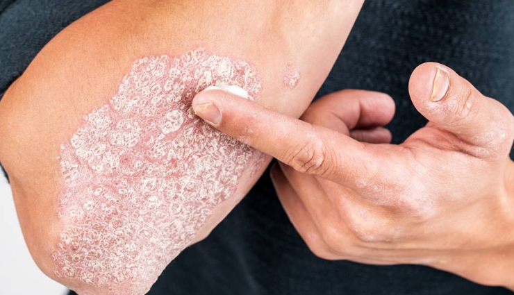 treat psoriasis at home,tips to treat psoriasis at home,healthy living,Health tips